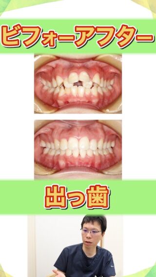 【出っ歯ビフォーアフター①・顎間ゴム使用】
出っ歯の矯正治療のbefore→after症例について

こばやし矯正歯科
公式サイトはこちら▼
https://kobayashi-orthodental.com

#名古屋市守山区 
#矯正医
#矯正専門歯科
#日本矯正歯科学会認定医
#歯列矯正
#こども矯正
#歯のガタガタ
#出っ歯
#上顎前突
#ビフォーアフター