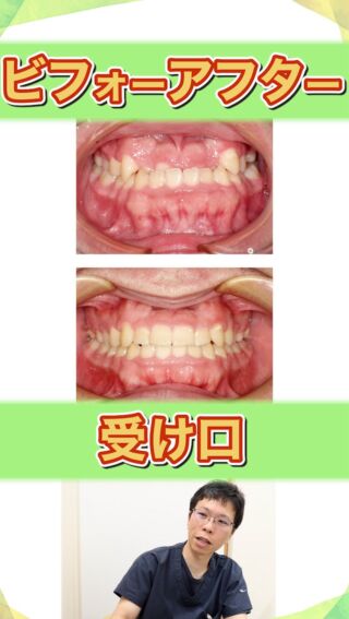 【反対咬合（受け口）・ビフォーアフター】

反対咬合のビフォーアフターについて

こばやし矯正歯科
公式サイトはこちら▼
https://kobayashi-orthodental.com

#名古屋市守山区 
#矯正医
#矯正専門歯科
#日本矯正歯科学会認定医
#歯列矯正
#こども矯正
#歯のガタガタ
#反対咬合
#受け口
#過蓋咬合
#ビフォーアフター