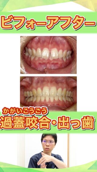 【過蓋咬合ビフォーアフター①】
深いかみ合わせと出っ歯を同時に改善した症例

こばやし矯正歯科
公式サイトはこちら▼
https://kobayashi-orthodental.com

#名古屋市守山区 
#矯正医
#矯正専門歯科
#日本矯正歯科学会認定医
#歯列矯正
#こども矯正
#歯のガタガタ
#出っ歯
#上顎前突
#過蓋咬合
#ビフォーアフター