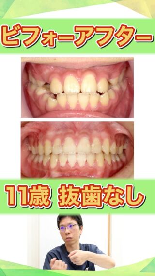 【非抜歯ビフォーアフター②】
奥歯を後ろに動かして非抜歯で仕上げた矯正治療

こばやし矯正歯科
公式サイトはこちら▼
https://kobayashi-orthodental.com

#名古屋市守山区 
#矯正医
#矯正専門歯科
#日本矯正歯科学会認定医
#歯列矯正
#こども矯正
#歯のガタガタ
#非抜歯
#SMC
#ワイヤー矯正
#ビフォーアフター