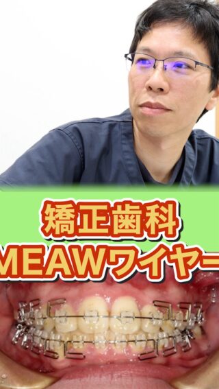 【MEAWワイヤー矯正】通常のワイヤー矯正との違いをわかりやすく解説

こばやし矯正歯科
公式サイトはこちら▼
https://kobayashi-orthodental.com

#名古屋市守山区 
#矯正医
#矯正専門歯科
#日本矯正歯科学会認定医
#歯列矯正
#こども矯正
#大人の矯正
#MEAWワイヤー矯正
#MEAWワイヤー