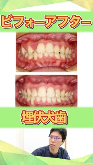 【埋伏犬歯とは？】矯正治療でどう対処するの？

こばやし矯正歯科
公式サイトはこちら▼
https://kobayashi-orthodental.com

#名古屋市守山区 
#矯正医
#矯正専門歯科
#日本矯正歯科学会認定医
#歯列矯正
#こども矯正
#大人の矯正
#埋伏歯
#MEAWワイヤー矯正
#MEAWワイヤー