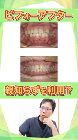 【親知らずを活かす矯正・ビフォーアフター】
56歳女性｜親知らずを利用した歯の移動（治療期間：2年8ヶ月）

こばやし矯正歯科
公式サイトはこちら▼
https://kobayashi-orthodental.com

#名古屋市守山区 
#矯正医
#矯正専門歯科
#日本矯正歯科学会認定医
#歯列矯正
#こども矯正
#大人の矯正
#親知らず
#親知らずを利用