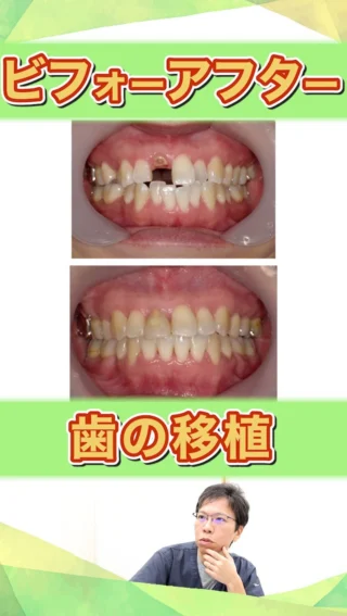 【前歯に歯を移植して矯正した症例】
前歯が折れた時に移植をすることによって矯正する方法。

こばやし矯正歯科
公式サイトはこちら▼
https://kobayashi-orthodental.com

#名古屋市守山区 
#矯正医
#矯正専門歯科
#日本矯正歯科学会認定医
#歯列矯正
#こども矯正
#大人の矯正
#移植
#歯を移植ビフォーアフター
#移植矯正